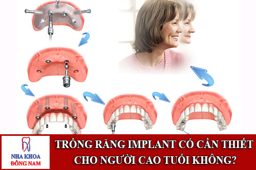 Trồng răng implant có cần thiết cho người cao tuổi không