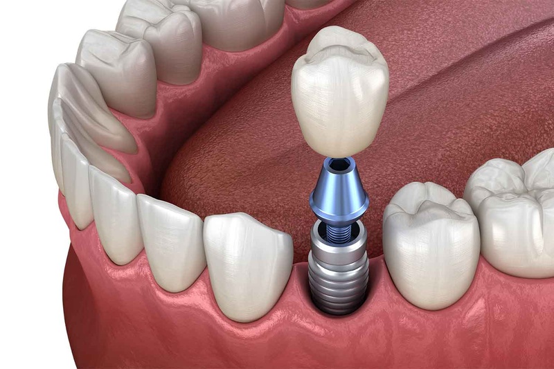 Trồng răng Implant có cấu trúc tương tự như răng thật
