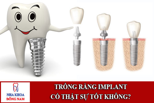 trồng răng implant có thật sự tốt không