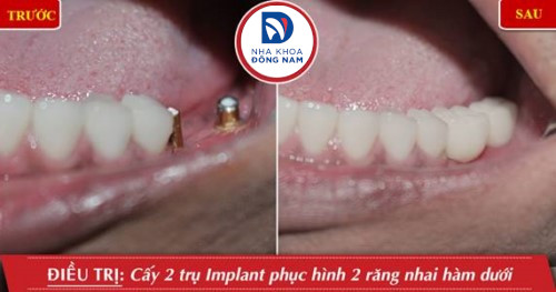 cấy 2 trụ implant răng hàm