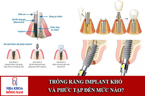 trồng răng implant khó và phức tạp đến mức nào?