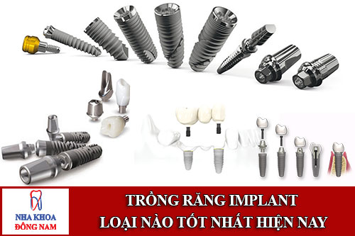 trồng răng implant loại nào tốt nhất hiện nay