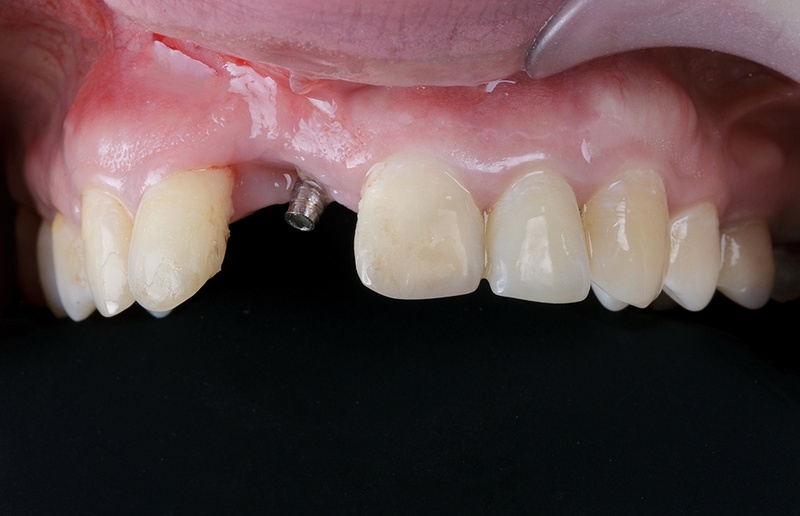 Trồng răng Implant phục hình răng mất