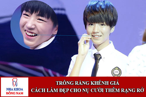 trồng răng khểnh giả - cách làm đẹp cho nụ cười thêm rạng rở 1