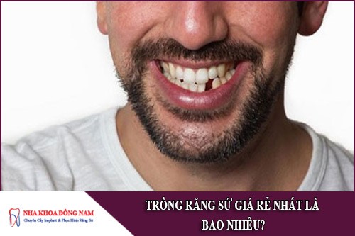 trồng răng sứ giá rẻ nhất bao nhiêu