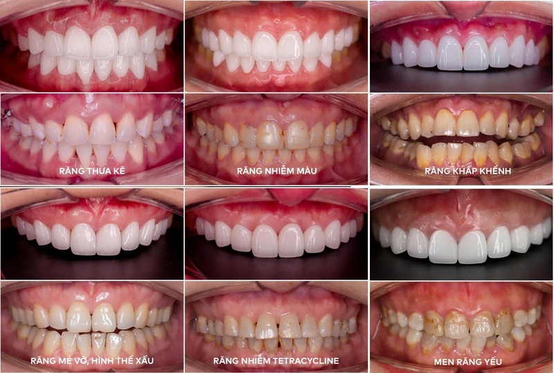 Trồng răng sứ thẩm mỹ khắc phục mọi khuyết điểm trên răng