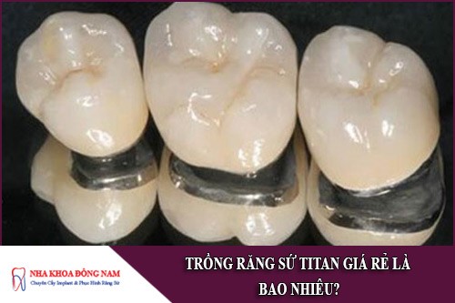 trồng răng sứ titan giá rẻ là bao nhiêu 1
