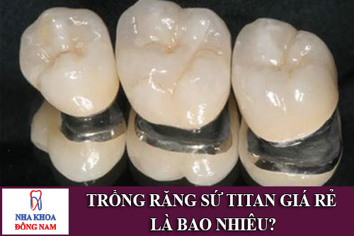 trồng răng sứ titan giá rẻ là bao nhiêu