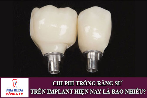 trong-rang-su-tren-implant-gia-bao-nhieu