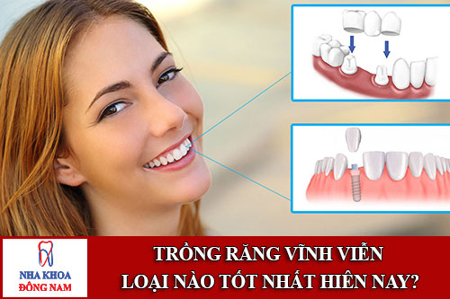 trồng răng vĩnh viễn loại nào tốt nhất hiên nay
