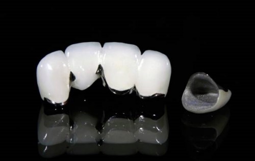 cấu tạo của răng sứ kim loại