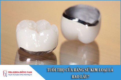 tuổi thọ của răng sứ kim loại là bao lâu