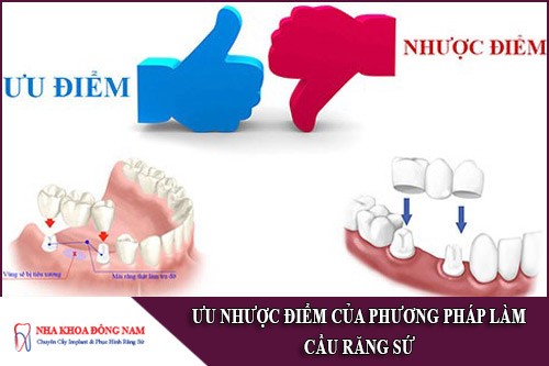 ưu nhược điểm của phương pháp làm cầu răng sứ