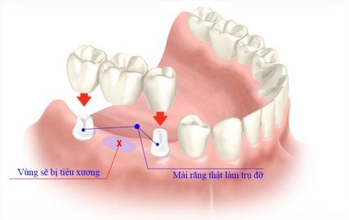 nhược điểm của cầu răng sứ