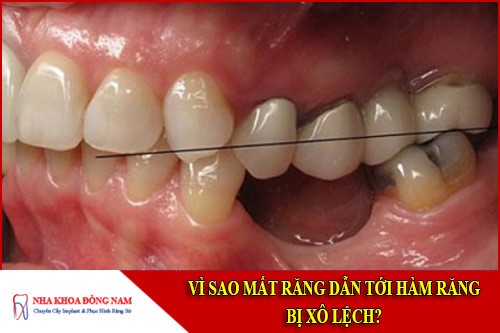 vì sao mất răng dẫn tới hàm răng bị xô lệch