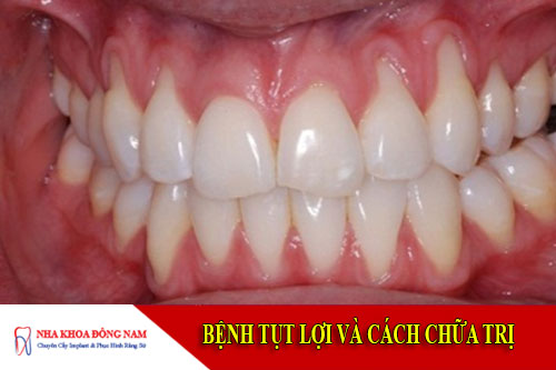 bệnh tụt lợi và cách chữa trị