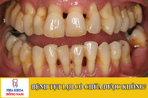 bệnh tụt lợi có chữa được không