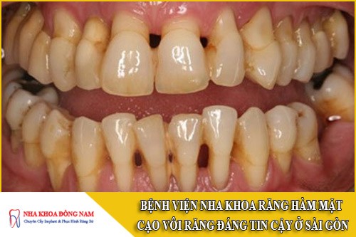 bệnh viện nha khoa răng hàm mặt cạo vôi răng đáng tin cậy ở Sài Gòn