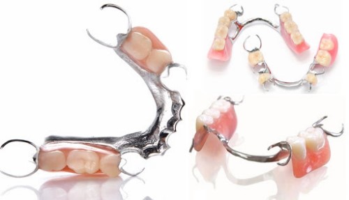 răng giả tháo lắp bán phần