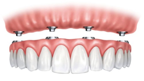 răng giả tháo lắp trên implant