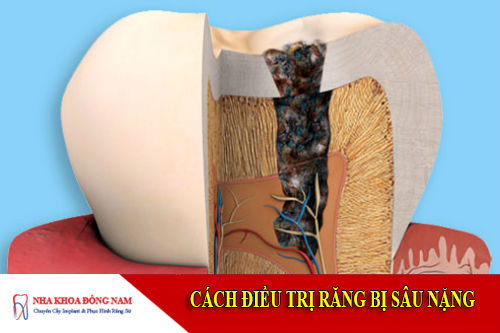 cách điều trị răng bị sâu nặng