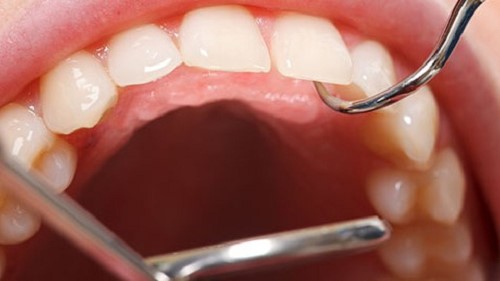 cạo vôi răng mất thời gian trong bao lâu 1