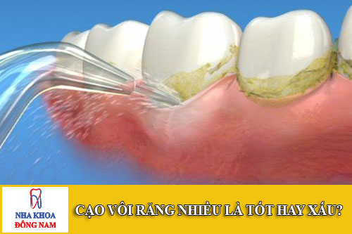 cạo vôi răng nhiều là tốt hay xấu