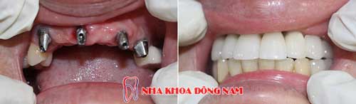 cấy ghép 4 trụ implant cho 6 răng đã mất - 10102016