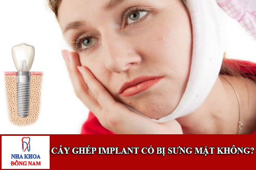 cấy ghép implant có bị sưng mặt không