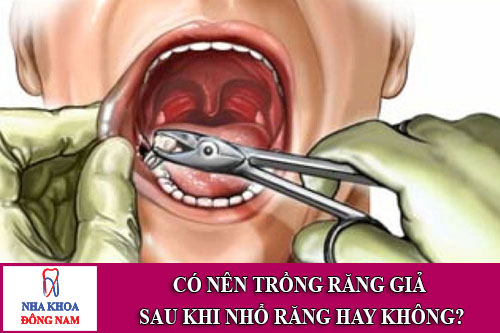 có nên trồng răng giả sau khi nhổ răng hay không