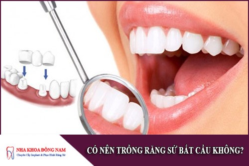 có nên trồng răng sứ bắt cầu không