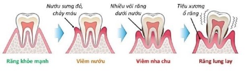 có phải răng bị lung lay là do chữa tủy 1