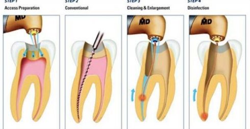 có phải răng bị lung lay là do chữa tủy