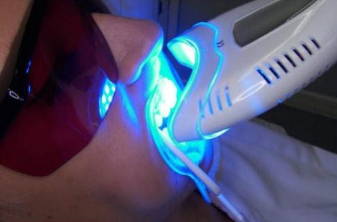 công nghệ tẩy trắng răng bằng đèn laser khác đèn zoom như thế nào 3