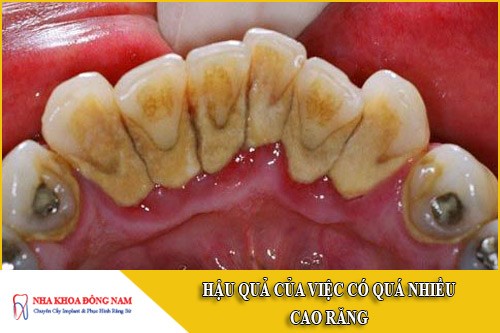 hậu quả của việc có quá nhiều cao răng
