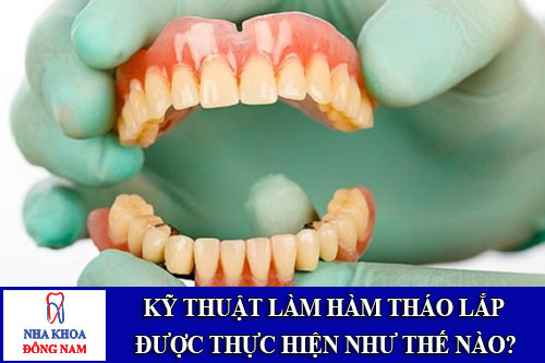 kỹ thuật làm hàm tháo lắp được thực hiện như thế nào