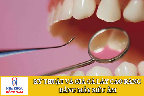 kỹ thuật và giá cả lấy cao răng bằng máy siêu âm