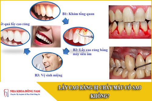 lấy cao răng bị chảy máu có sao không