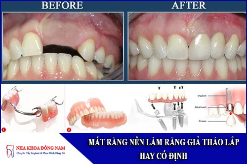 mất răng nên làm răng giả tháo lắp hay cố định