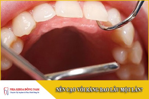 nên cạo vôi răng bao lâu một lần