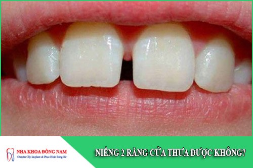 niềng 2 răng cửa thưa được không