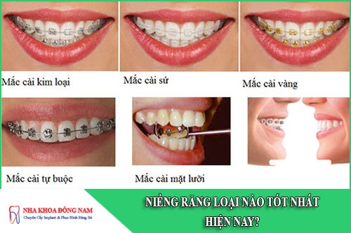 niềng răng loại nào tốt nhất hiện nay
