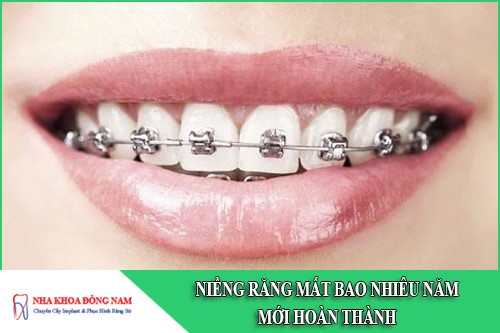 niềng răng mất bao nhiêu năm mới hoàn thành