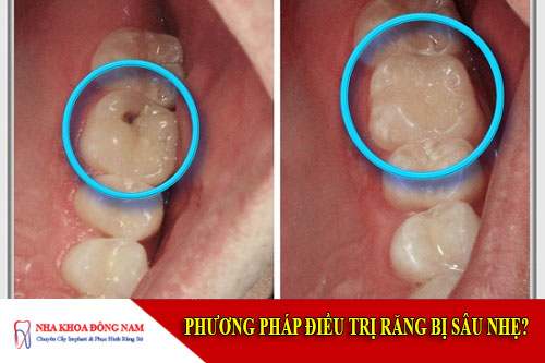 phương pháp điều trị răng bị sâu nhẹ