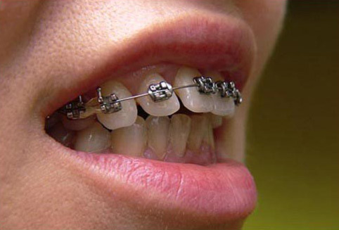 phương pháp điều trị răng hô không cần phẫu thuật