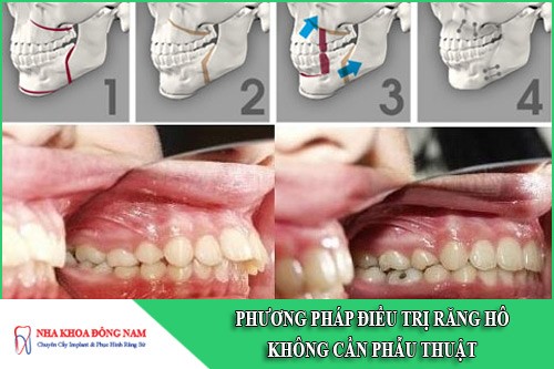 phương pháp điều trị răng hô không cần phẫu thuật