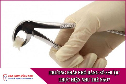 phương pháp nhổ răng số 8 được thực hiện như thế nào