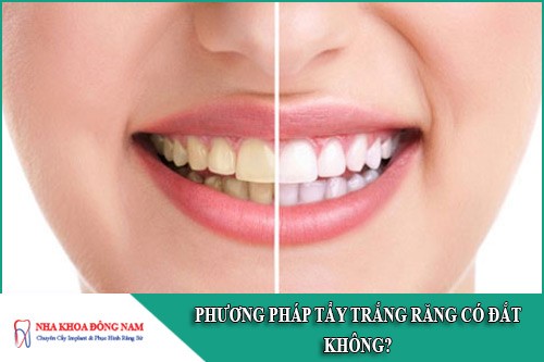 phương pháp tẩy trắng răng có đắt không