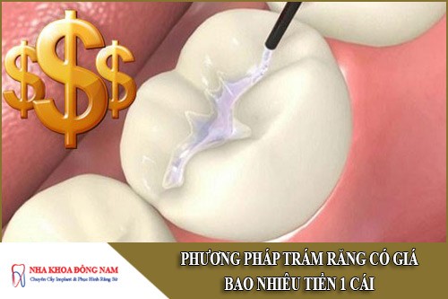 phương pháp trám răng có giá bao nhiêu tiền 1 cái