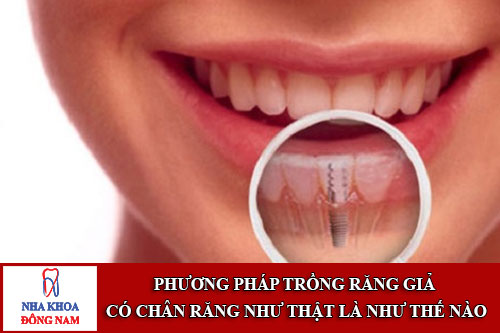 phương pháp trồng răng giả có chân răng như thật là như thế nào